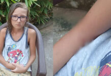 കോവളത്ത് റഷ്യന് ബാലന് തെരുവുനായയുടെ കടിയേറ്റു; 13കാരന് മെഡിക്കല് കോളജില് ചികിത്സയില്